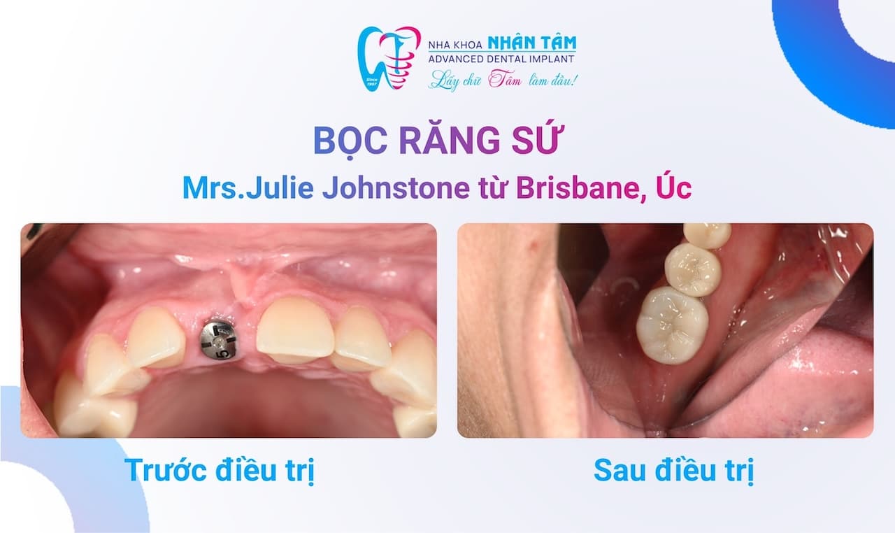 Từ Úc Bay Về Việt Nam – Chị J Đã Tự Tin Cười Thoải Mái Tại Nha Khoa Nhân Tâm