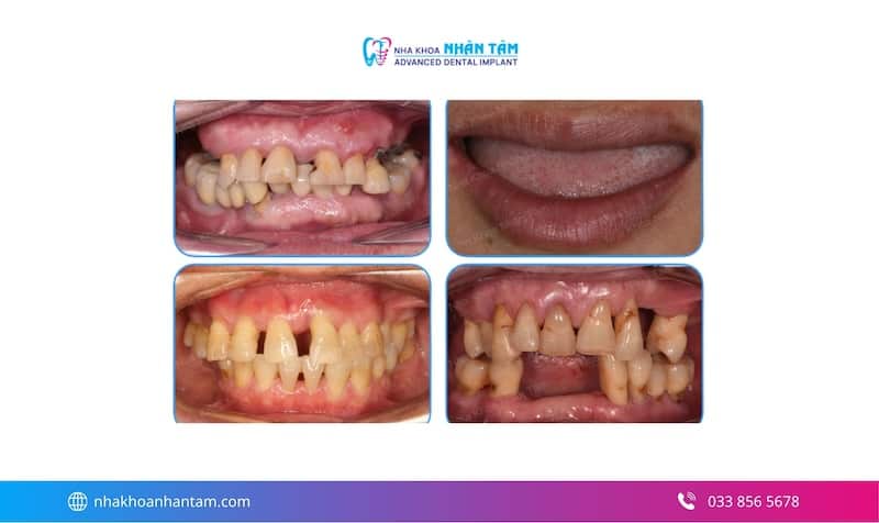 ưu điểm implant all on 4