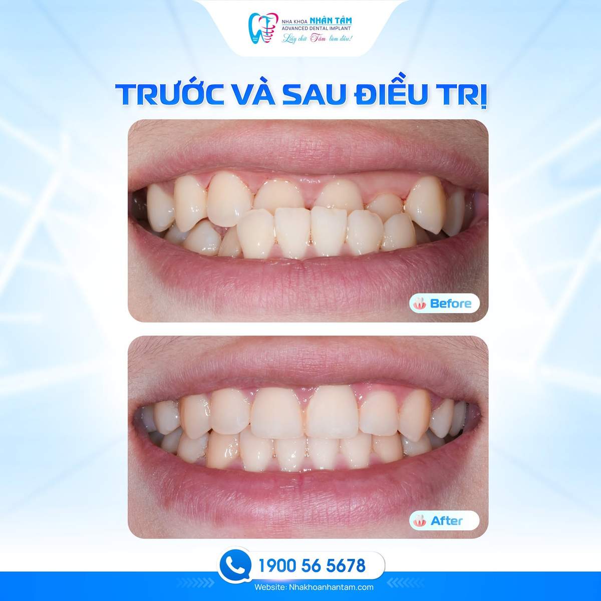 Hình: Niềng răng giúp sắp xếp răng đều hơn trên cung hàm