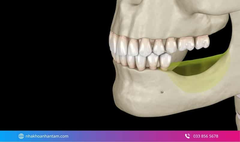 ưu điểm trồng răng implant toàn hàm