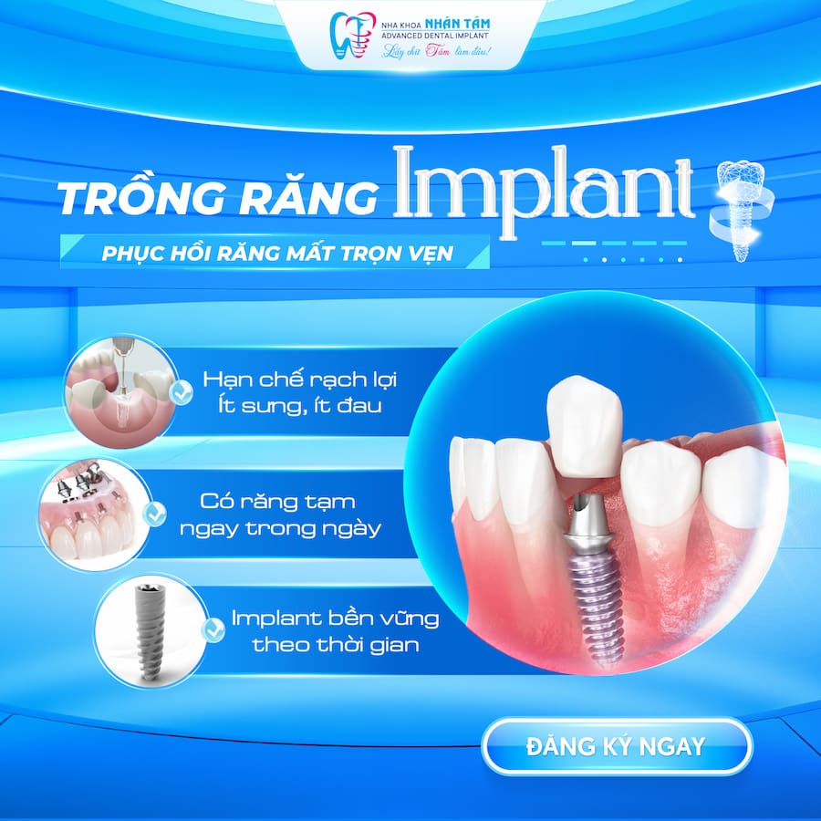 Ưu điểm trồng răng