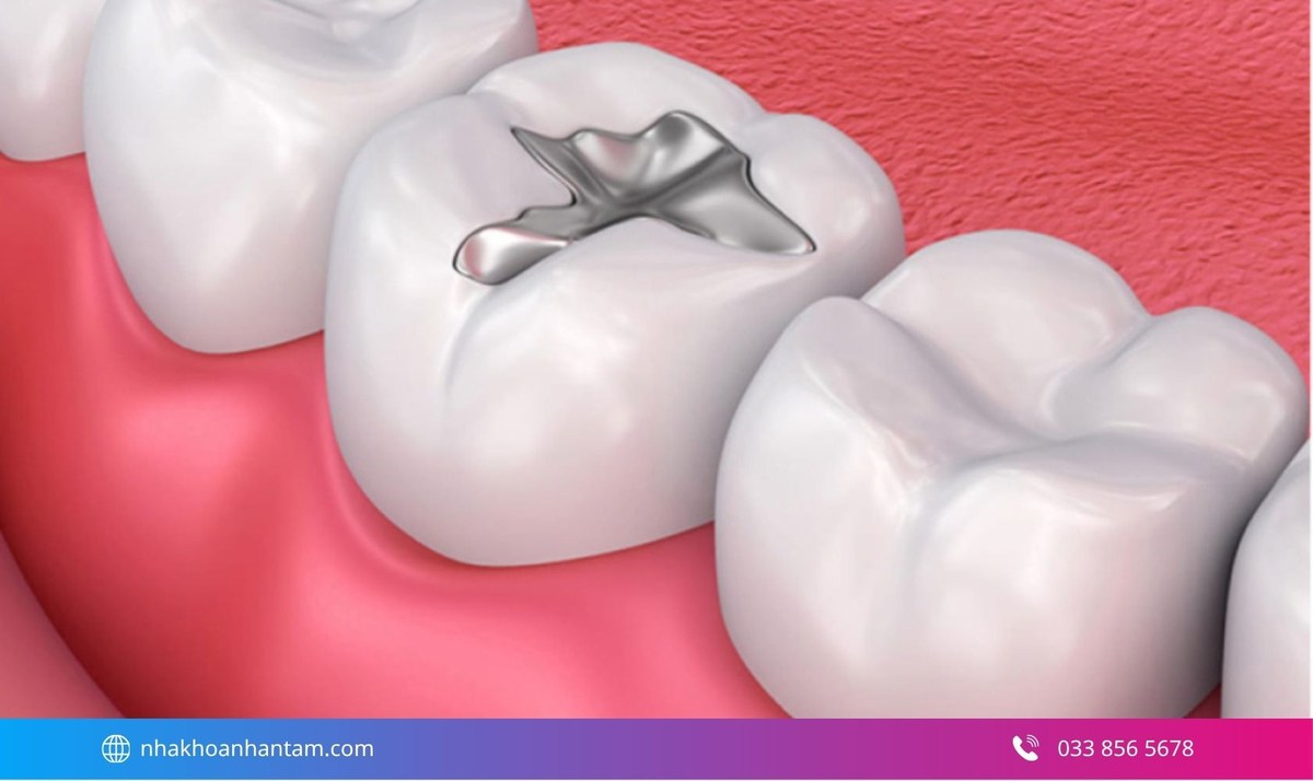 Amalgam là vật liệu có màu kim loại và từng được sử dụng phổ biến để phục hồi các răng hàm Hình: Amalgam là vật liệu có màu kim loại và từng được sử dụng phổ biến để phục hồi các răng hàm