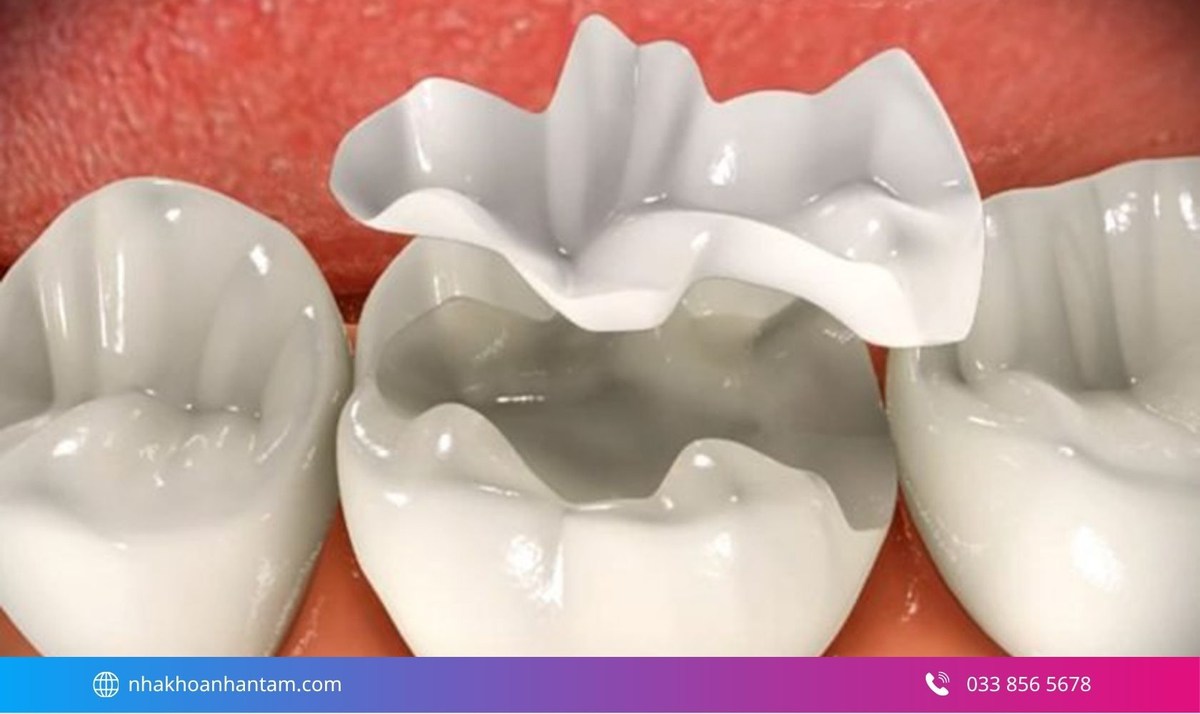 Composite là vật liệu có màu gần với răng tự nhiên Hình: Composite là vật liệu có màu gần với răng tự nhiên
