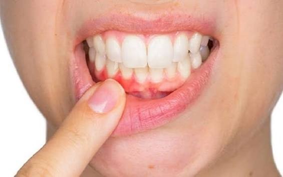 Cần phân biệt rõ giữa phản ứng kích ứng nướu tạm thời và tình trạng nhiễm trùng thực sự Hình: Cần phân biệt rõ giữa phản ứng kích ứng nướu tạm thời và tình trạng nhiễm trùng thực sự