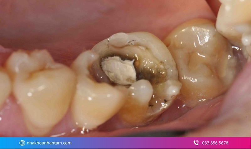 viêm tủy răng có nguy hiểm không