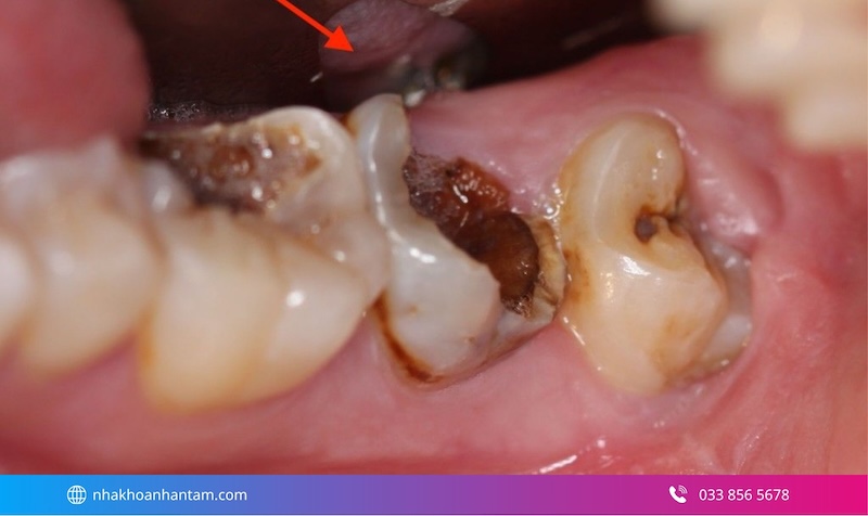 viêm tủy răng có tự khỏi không