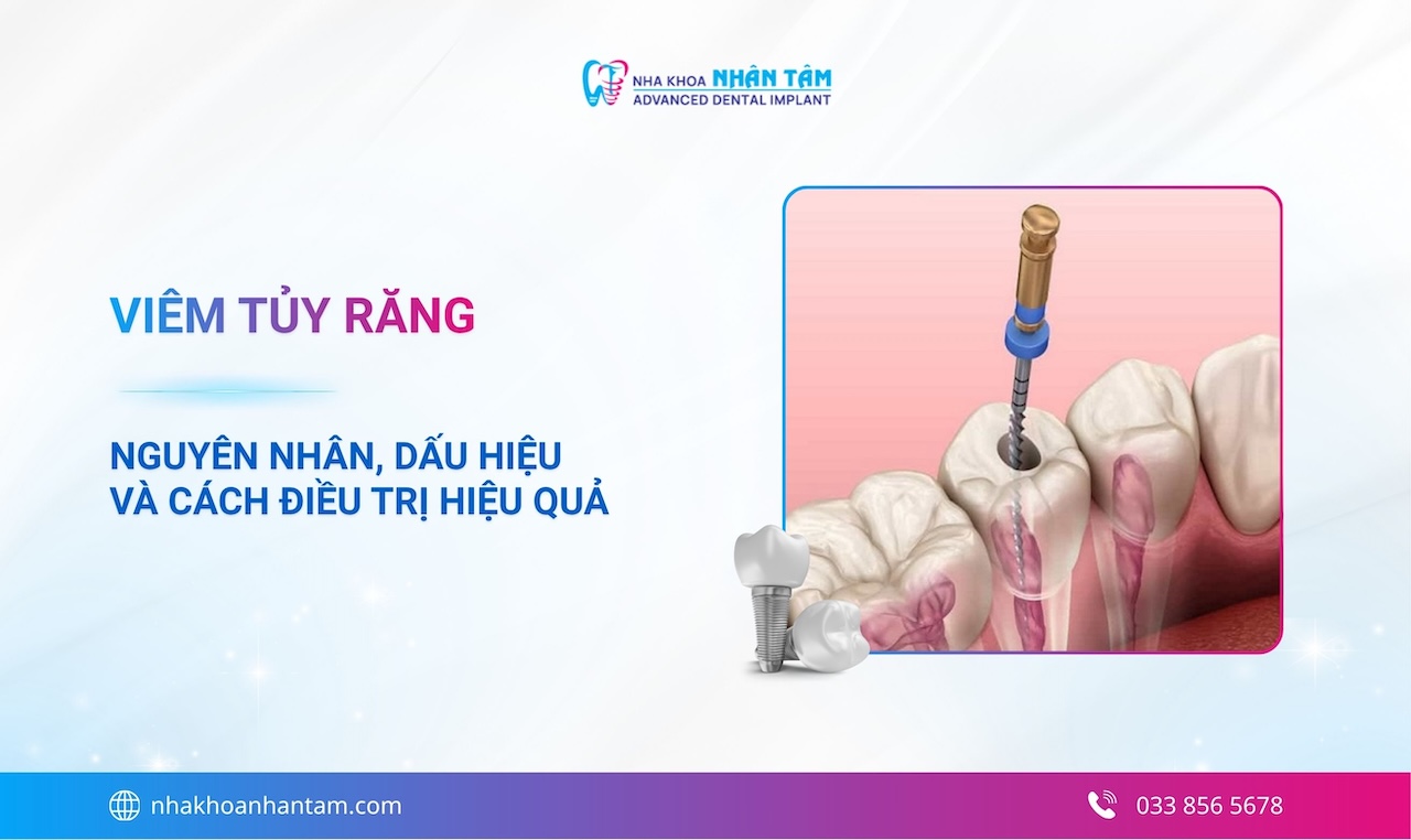 Viêm tủy răng: Nguyên nhân, dấu hiệu và cách điều trị hiệu quả