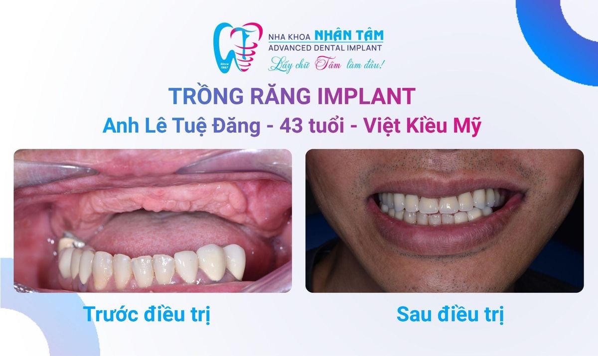 Anh Lê Tuệ Đăng (Việt kiều Mỹ) – Câu chuyện khách hàng tại Nha khoa Nhân Tâm Hình: Anh Lê Tuệ Đăng (Việt kiều Mỹ) – Câu chuyện khách hàng tại Nha khoa Nhân Tâm