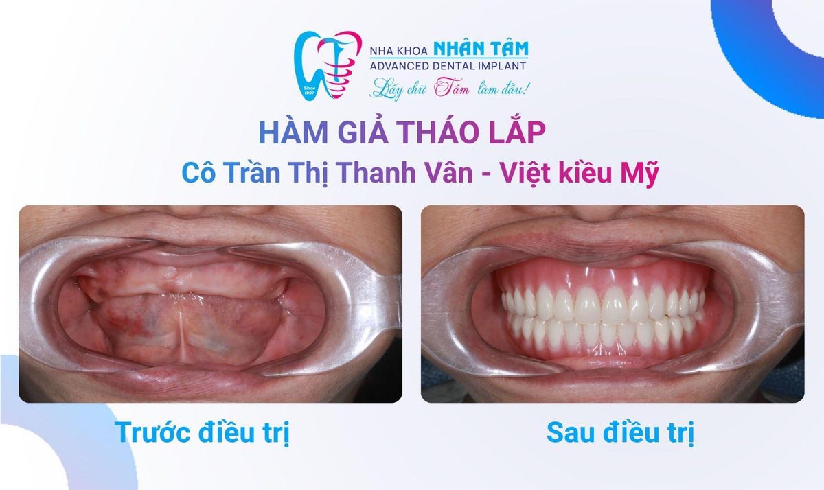 Cô Vân (Việt kiều Mỹ) – Câu chuyện khách hàng tại Nha khoa Nhân Tâm Hình: Cô Vân (Việt kiều Mỹ) – Câu chuyện khách hàng tại Nha khoa Nhân Tâm