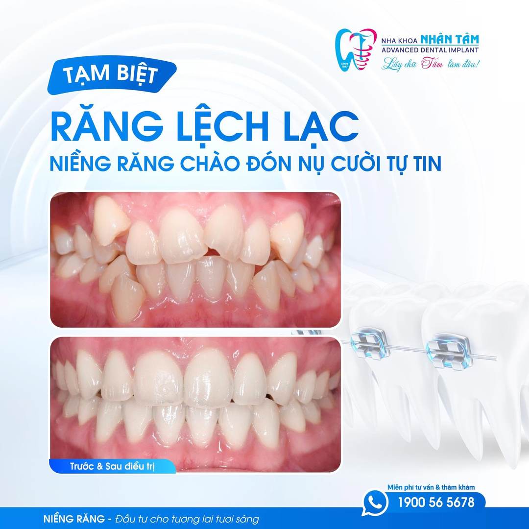 Hình: Có thể vừa niềng vừa bọc sứ khi lập kế hoạch điều trị ngay từ đầu