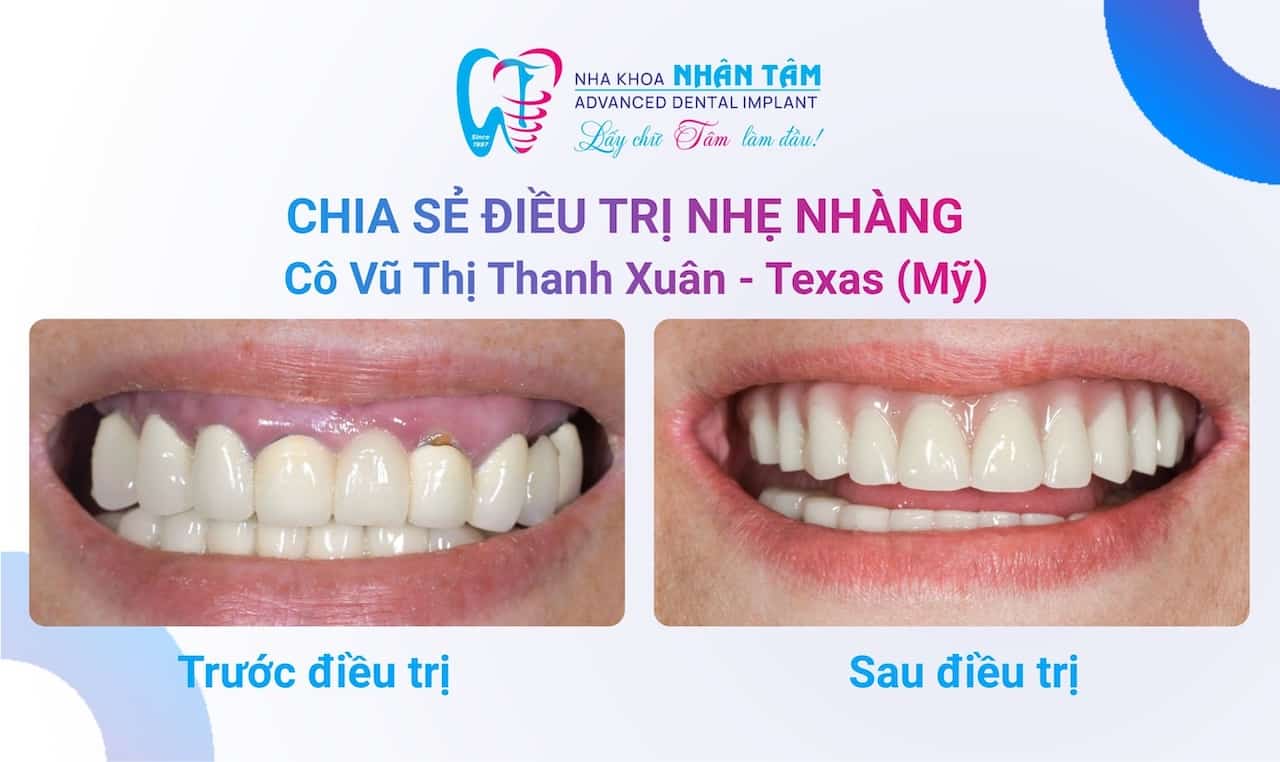 Vượt qua nỗi sợ làm răng sau khi trải nghiệm dịch vụ tại Nhân Tâm