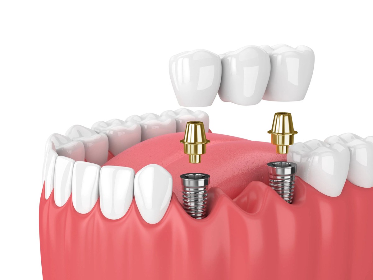 Hình: Khi phát hiện implant bị đào thải, bạn hãy sắp xếp đến để gặp bác sĩ càng sớm càng tốt