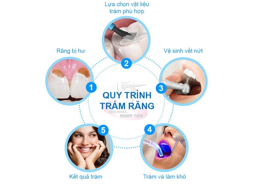 Quy trình trám răng tại Nha khoa Nhân Tâm