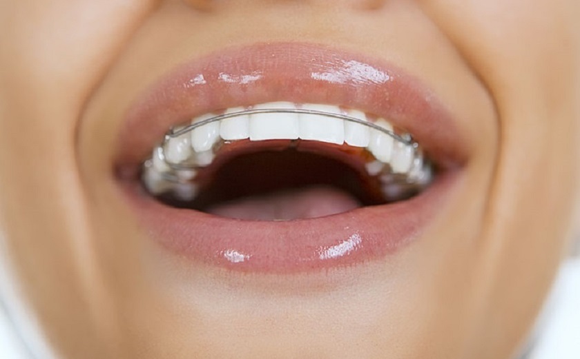 Cần đeo hàm duy trì để răng ổn định lại sau khi niềng