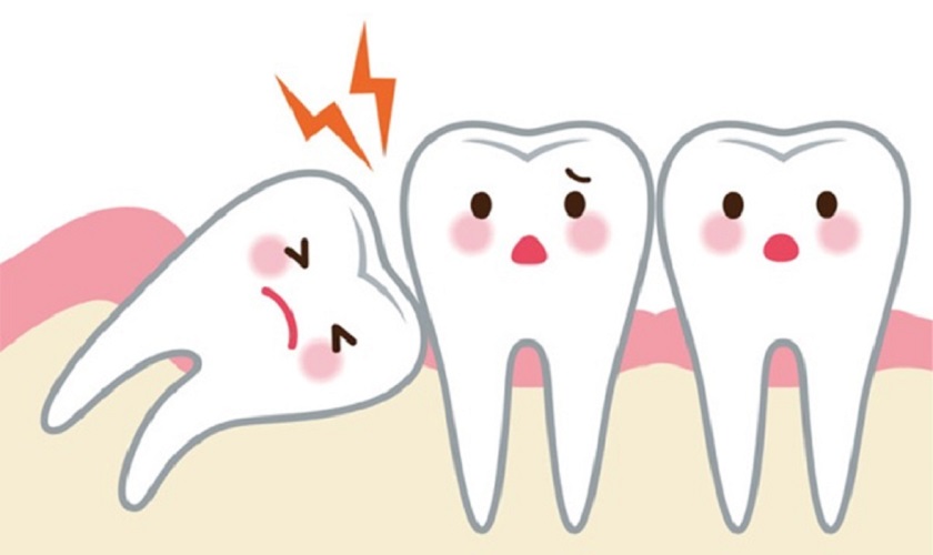 5 cách giảm đau khi mọc răng khôn hiệu quả ngay tại nhà