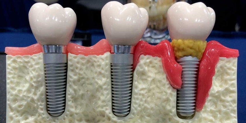 Viêm nhiễm khu vực cấy ghép Implant