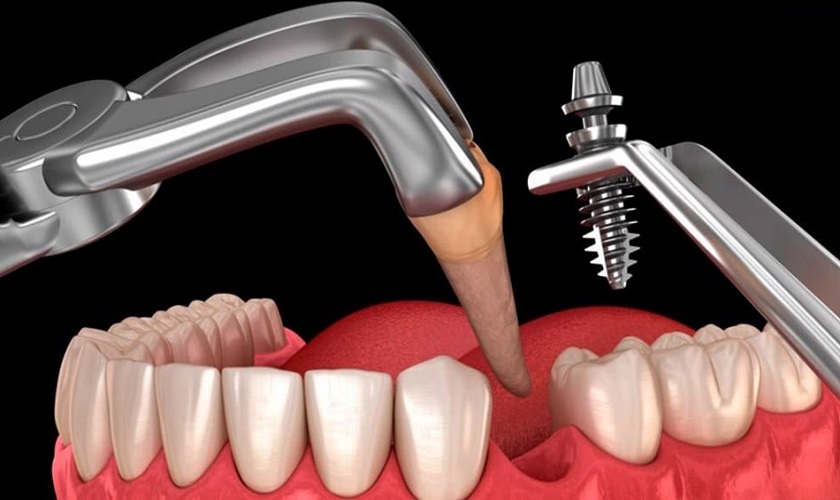 Nhổ răng sâu nặng và phục hình lại với Implant nha khoa