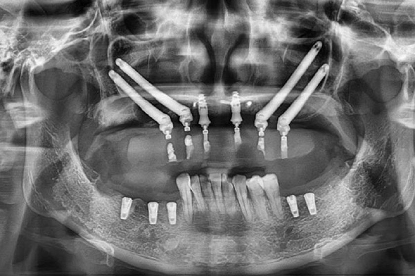 Trồng Implant xương gò má