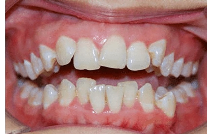 Làm đều, phẳng cung răng là giai đoạn đầu tiên trong chỉnh nha