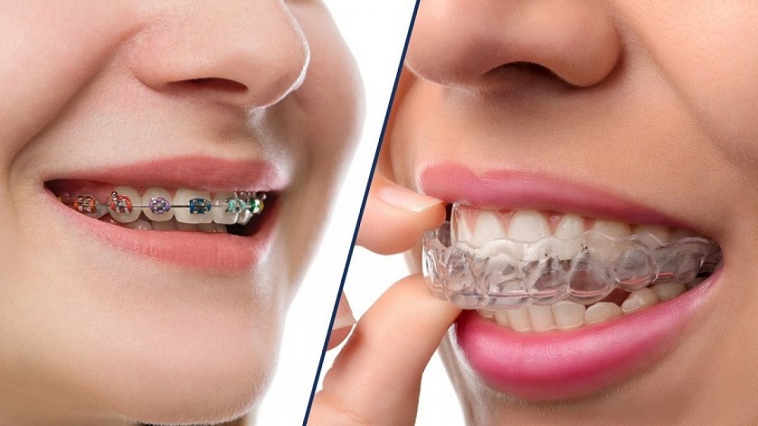 Niềng răng trong suốt Invisalign