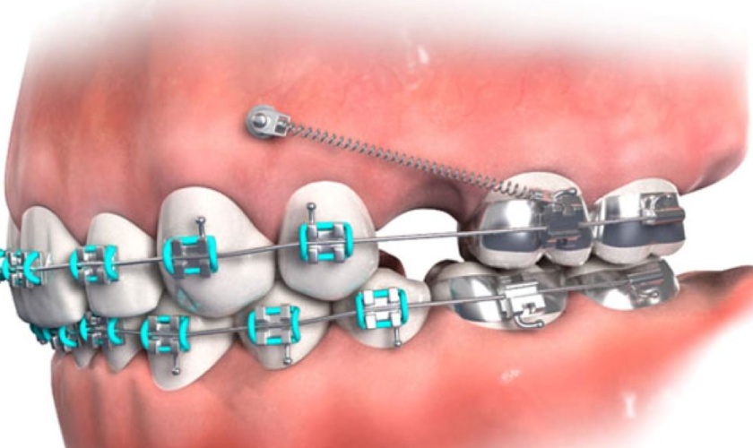 Vít niềng răng được làm từ titanium rất lành tính, an toàn với cơ thể