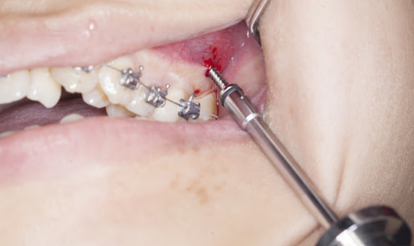 Vít niềng răng giúp việc nắn chỉnh răng được dễ dàng hơn