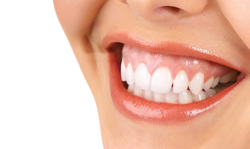 Sử dụng vít niềng răng sẽ giúp cải thiện cười hở lợi nhanh chóng