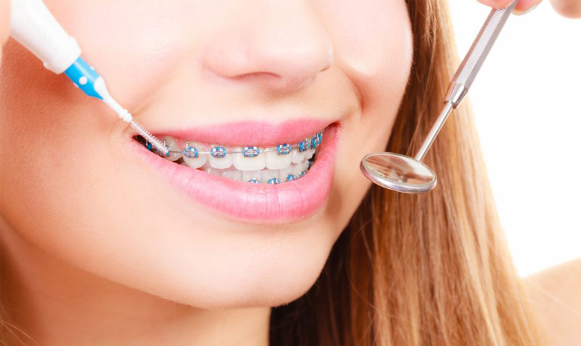 Giá niềng răng tùy thuộc vào phương pháp niềng răng mà bạn lựa chọn