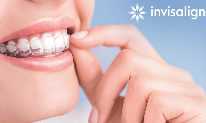 Niềng răng Invisalign đem lại những hiệu quả vô cùng tuyệt vời