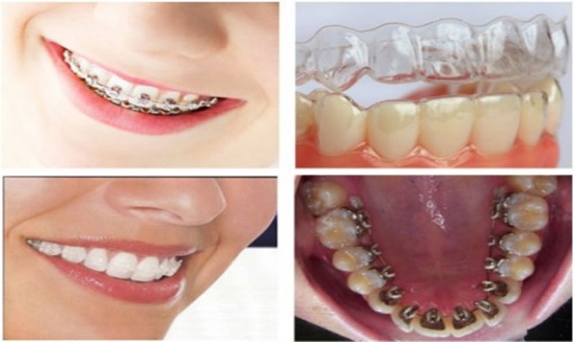 Một số loại mắc cài niềng răng phổ biến
