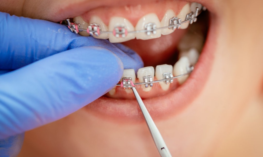 Niềng răng có đau không là thắc mắc của nhiều người