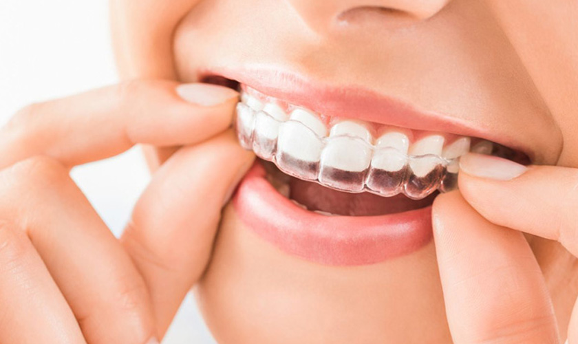 Niềng răng Invisalign có tính thẩm mỹ ưu việt