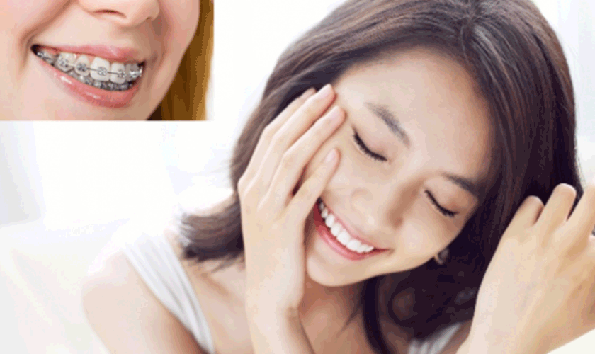 Niềng răng mắc cài thích hợp cho tất cả các tình trạng lệch lạc răng