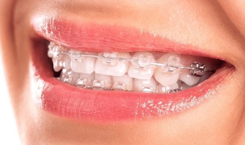 Niềng răng mắc cài sứ là phương pháp được ưa chuộng hiện nay