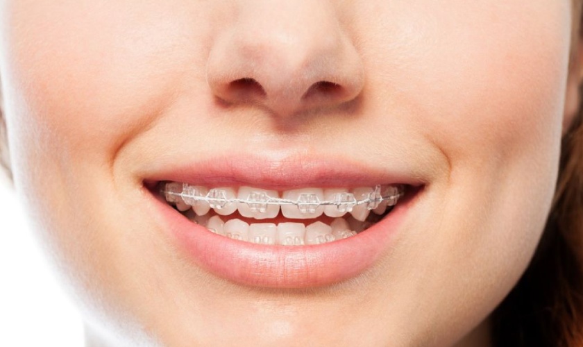 Mắc cài sứ đảm bảo thẩm mỹ trong khi niềng