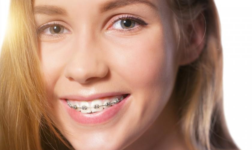Niềng răng giúp nụ cười tươi tắn, rạng rỡ