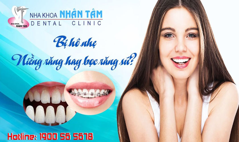 Bị hô nhẹ thì nên niềng răng hay bọc răng sứ?