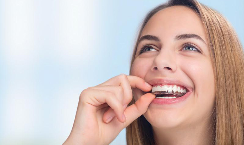 Một số loại hình niềng răng phổ biến  các kiến thức cơ bản cần biết  Nha  Khoa Home