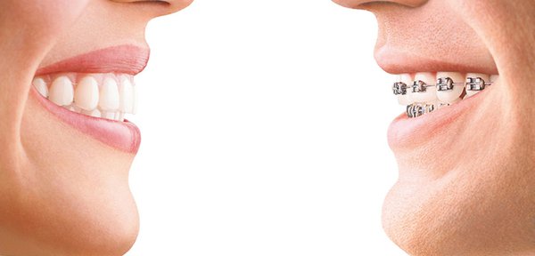 Niềng răng có đau không? Những giai đoạn khi niềng răng