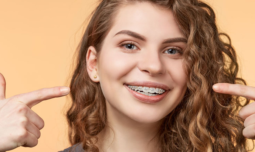 Niềng răng mắc cài tự khóa