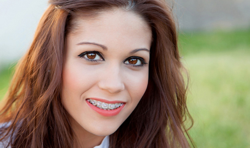 Thông thường 1 ca niềng răng mất khoảng 18-24 tháng