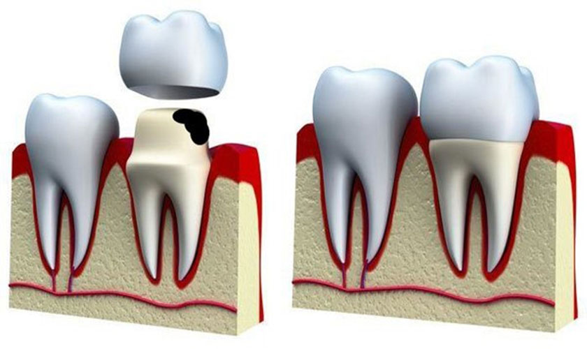 Sâu răng có niềng răng được hay không