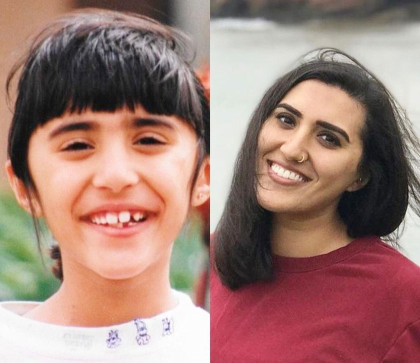 Dậy thì thành công sau khi niềng răng