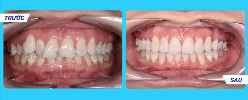 Trước và sau niềng răng tại Nha khoa Nhân Tâm