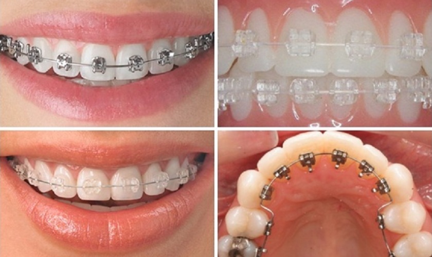 Các phương pháp niềng răng hiện nay