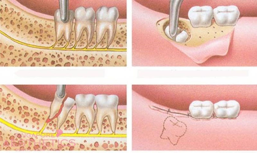 Nhổ răng khôn khi niềng răng Invisalign mang lại thẩm mỹ cao vì không ai có thể nhìn thấy dấu tích khi nhổ răng