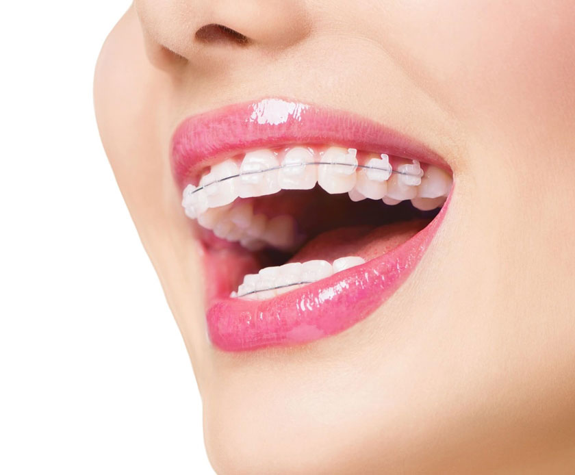 Niềng răng thẩm mỹ