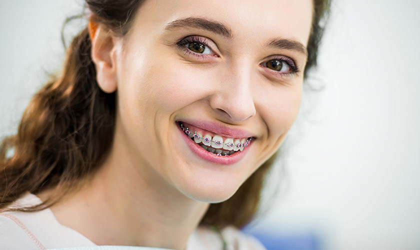 Niềng răng mắc cài tự khóa