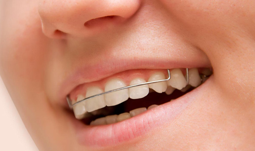 Người trưởng thành hoàn toàn có thể niềng răng thẩm mỹ