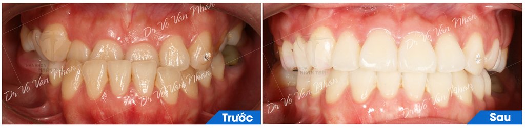 Một số trường hợp dùng lực nhẹ để chỉnh nha nhưng vẫn đạt hiệu quả cao tại Nha Khoa Nhân Tâm